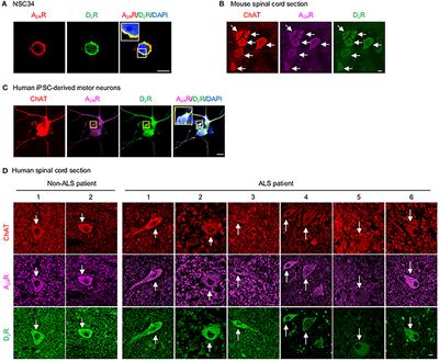 The D2 Dopamine Receptor Interferes With the Protective Effect of the A2A Adenosine Receptor on TDP-43 Mislocalization in Experimental Models of Motor Neuron Degeneration